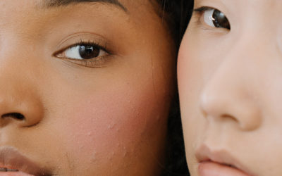 Comment se débarrasser de l’acné naturellement ?